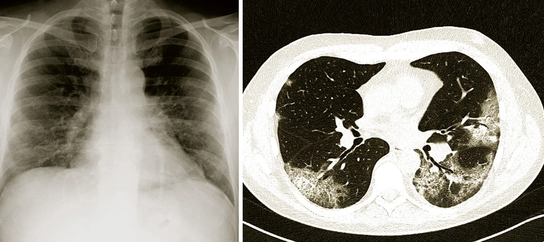 Vesmír/Radiodiagnostická klinika Nemocnice Na Bulovce: Snímky plic provedené různými technikami u téhož pacienta s těžkým průběhem nemoci covid-19. Na prvém obrázku (vlevo) je klasický Rtg snímek hrudníku, kde je oboustranně v dolních polích plicních lehce snížená transparence a zvýšená bronchovaskulární kresba – poměrně mírný rozsah tohoto nálezu dostatečně nekoresponduje se závažností respirační insuficience. Druhý snímek (vpravo) získaný počítačovou tomografií (CT) ukazuje neostře ohraničené okrsky tzv. „opacit mléčného skla“ a „crazy paving“, které jsou typické pro plicní postižení při nemoci covid-19. Tento nález lépe osvětluje těžký průběh onemocnění.